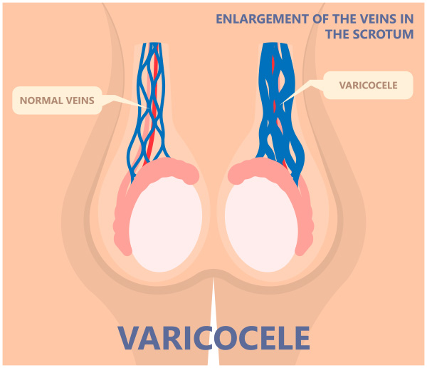 Varicocele Varicocele
