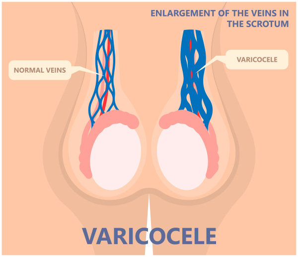 Varicocele