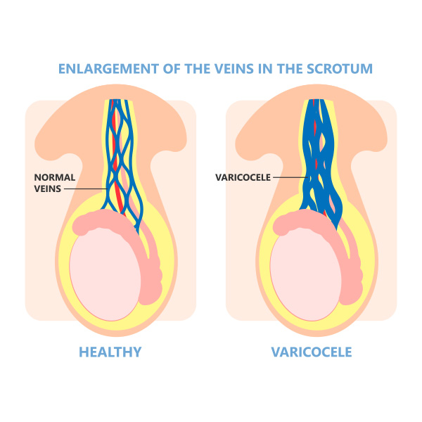 enlargement of the veins in the scrotum