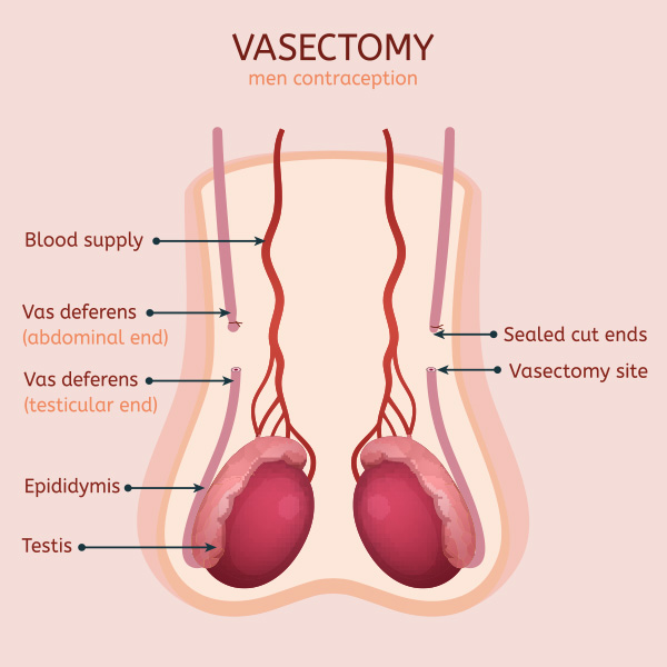 vasectomy vasectomy