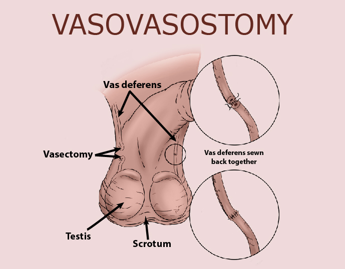 Vasovasostomy