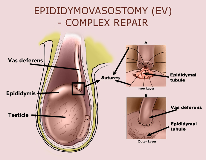 Epididymovasostomy