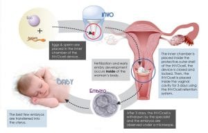 INVOcell | Atlantic Reproductive Medicine Speacialist