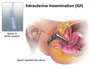 intrauterine insemination diagram