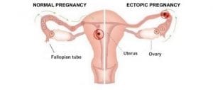 Image source: http://motherhow.com/ectopic-pregnancy/