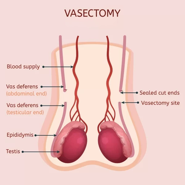 Vasectomy infographic Vasectomy infographic