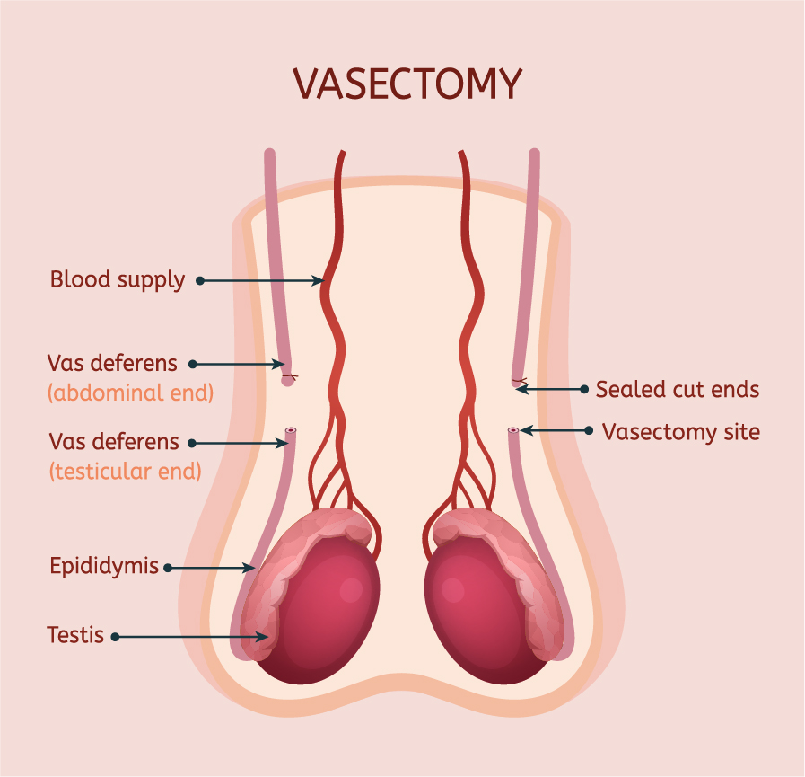 vasectomy-male contraception
