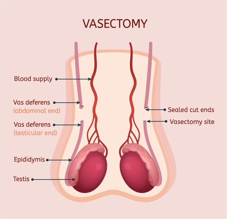 vasectomy_male_contraception vasectomy-male contraception
